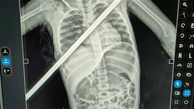 إنقاذ حياة طفلة اخترق صدرها سيخ حديد بمستشفيات بنها الجامعية