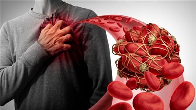 استشاري قلب يحذر: المتعافون من كورونا أكثر عرضة للإصابة بالجلطات 