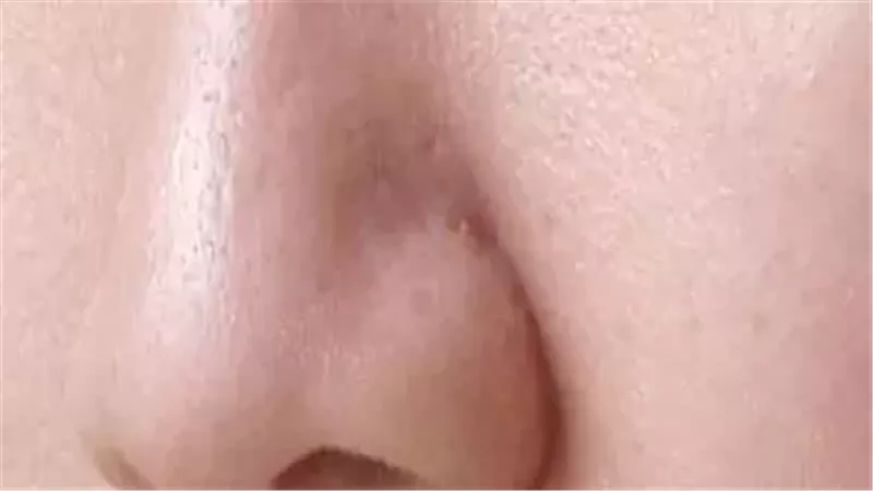 البثور السوداء 