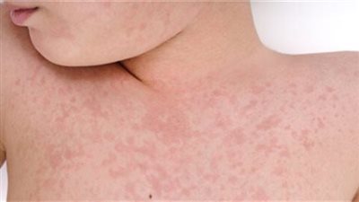 نصائح للعناية بجلد الطفل فى الصيف لحمايته من التسلخات