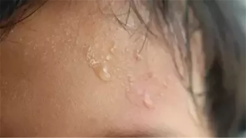 تعرق الأطفال 