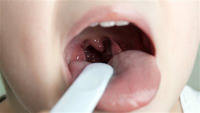 أعراض التهاب اللوزتين، ومتى يتم استئصالها؟