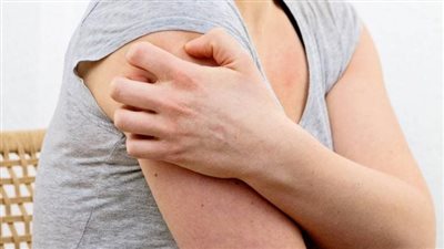 أسباب وأعراض إلتهاب الغدد العرقية القيحي وطرق العلاج والوقاية 