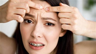 وصفات طبيعية سريعة المفعول لعلاج حبوب الجبهة الصيفية