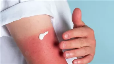 احذري.. كريم الشمس غير كاف لحماية طفلك من الحروق 