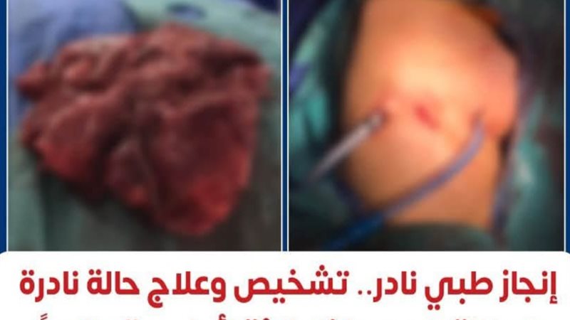 إنجاز طبي نادر 