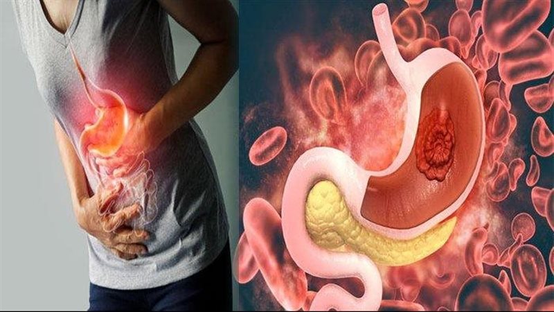 قرحة المعدة وأعراضها