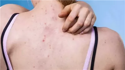 أسباب ظهور حب الشباب في الظهر 