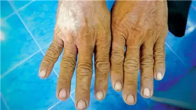 أعراض تصلب الجلد المناعي وأسباب الإصابة به وطرق العلاج 