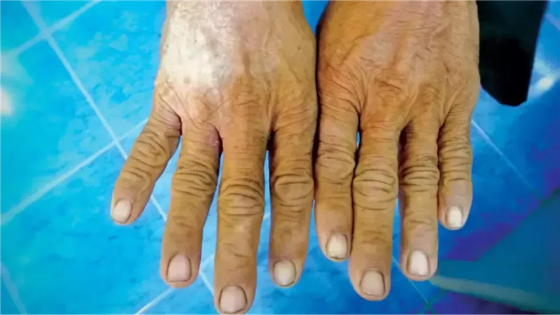 تصلب الجلد المناعي