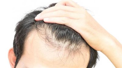 علاج تساقط الشعر| تقنية جديدة لعلاج الصلع لدى الرجل
