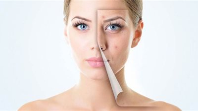 أسرع 7 علاجات للتخلص من حب الشباب نهائيا
