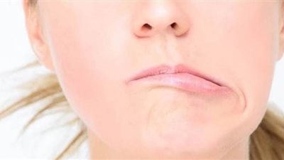 أعراض الإصابة بالتهاب العصب السابع وأفضل طرق العلاج