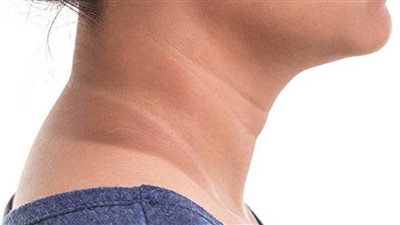  اسمرار الرقبة.. الأسباب وطرق العلاج 