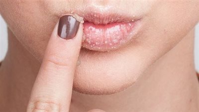  5 خطوات تخلصك من جفاف وتشققات الشفاه فى الشتاء