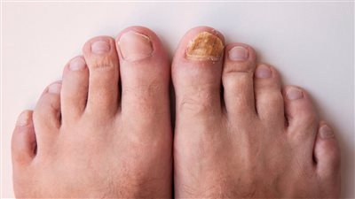 تحذير قبل فوات الأوان.. دراسة: تغيير أظافر القدمين من علامات 