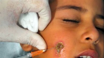 كابوس شرق المتوسط يصيب مليون إنسان سنويا.. مرض الليشمانيات الجلدي يضرب 70% من الإقليم 