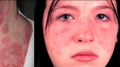 أعراض الذئبة الحمراء.. وأسباب الإصابة وطرق العلاج