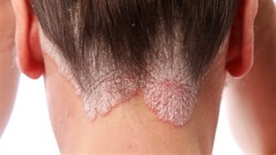 ماذا تفعل القشرة في الشعر وكيف يمكن القضاء عليها؟