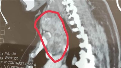 نجاح أول عملية استئصال ورم كلي للغدة الدرقية فى المنيا