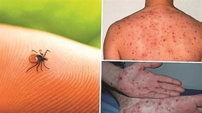 حمى القرم النزفية.. أزمة جديدة تضرب افريقيا من بوابة موريتانيا 