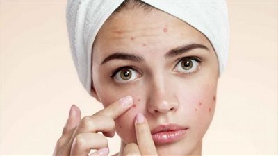 علاج حبوب الوجه بمواد طبيعية موجودة في مطبخك