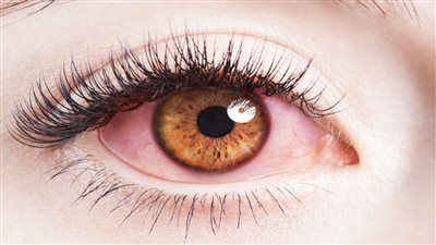 أعشاب تساعدك على علاج التهاب العينين.. اعرفيها