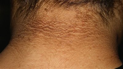 علامات تؤكد إصابتك بمرض السكر خلال شهور