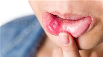  أسباب قرحة الفم وطرق علاجها منزليا