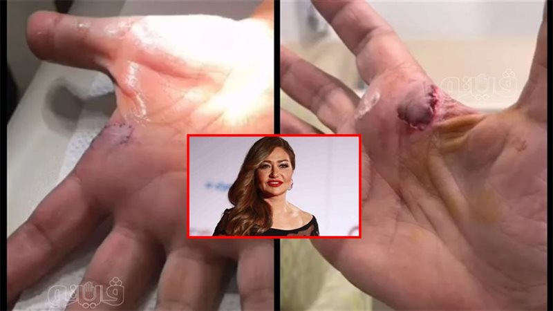 إصابة الفنانة ليلى