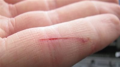 5 أخطاء يجب تجنبها عند التعامل مع الجروح 