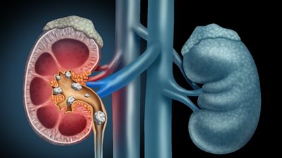 أعراض حصوة الكلى بالتفصيل