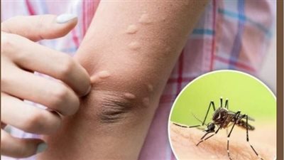 بعد وفاة حالتين.. انتشار التهاب الدماغ الياباني في استراليا يسبب الذعر