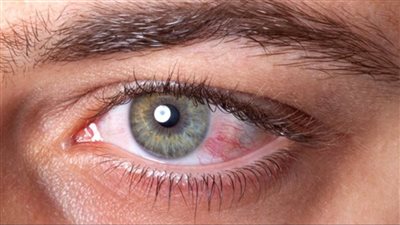 هل يؤثر فيروس كورونا على العين.. استشاري يجيب