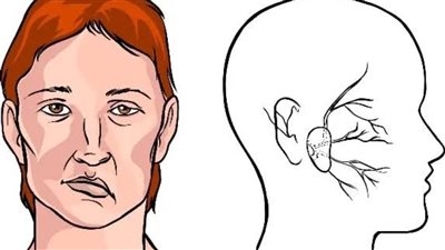 أسباب شلل الوجه النصفي وكيفية علاجه