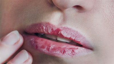 ما علاقة جفاف الشفايف بنقص الفيتامينات في الجسم؟.. أخصائية تُجيب