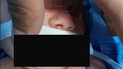 نجاح جراحة دقيقة لطفلة عمرها ساعات باستئصال ورم في الفم|صور