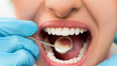 نصيحة مهمة من الصحة قبل بدء صيام رمضان لأصحاب تسوس الأسنان 