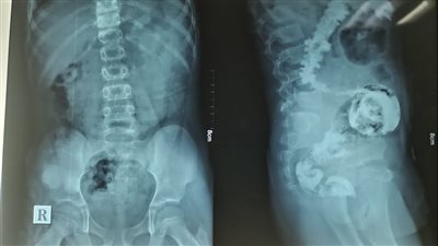 أطباء مستشفى بنها النموذجي ينقذون حياة طفل باستئصال جزء من المستقيم والقولون