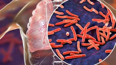 انخفاض معدلات الدرن في السعودية بنسبة 21% خلال 2022