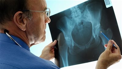 هيئة الدواء توضح طرق علاج هشاشة العظام 