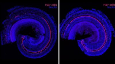 بشرى لفاقدي السمع.. تقنية جديدة لتحفيز خلايا الشعر داخل الأذن الداخلية
