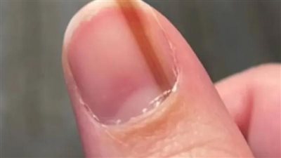 أمريكية عانت من خط تحت ظفرها لـ 10 سنوات ثم اكتشفت الصدمة