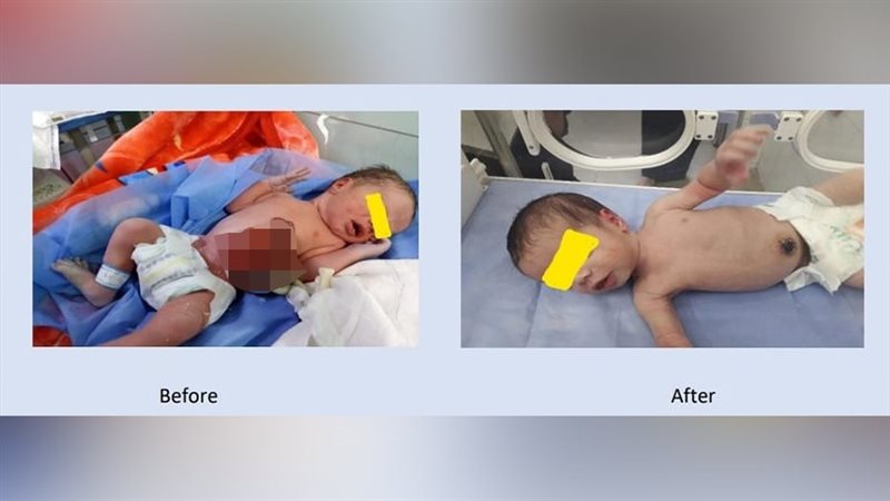 جراحة نادرة تنقذ