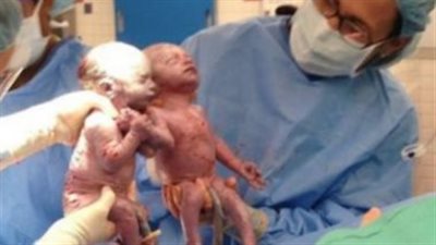 ولادة نادرة لتوأم في إسبانيا.. تحدث كل 85 ألف حالة 