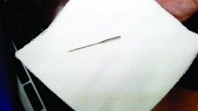 استخراج إبرة مفقودة في حوض مريضة من 10 سنوات