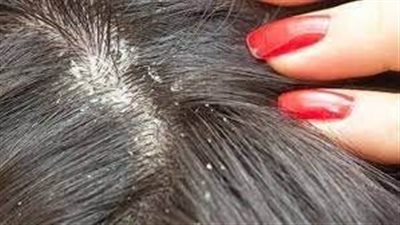 تفسير حلم القشرة في الشعر وعلاقتها بالوقوع في أزمات مالية 