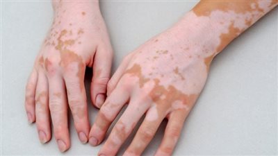 تفسير حلم مرض البهاق في المنام وعلاقته بالهموم والأحزان والأزمات النفسية