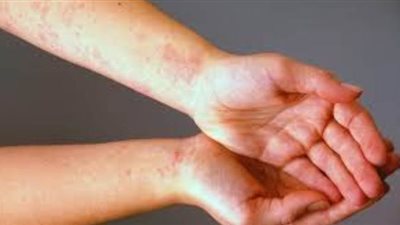 اكتشف أنواع الحساسية الجلدية وأعراضها وطرق التعامل معها