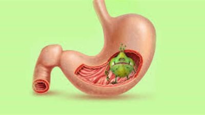وصفة طبيعية من الأعشاب لعلاج جرثومة المعدة في البيت